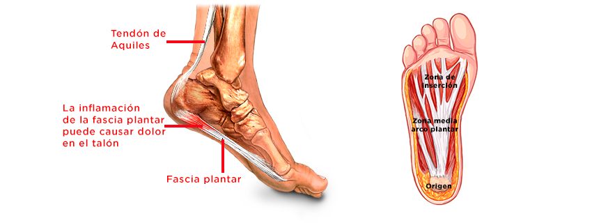 Fascitis plantar